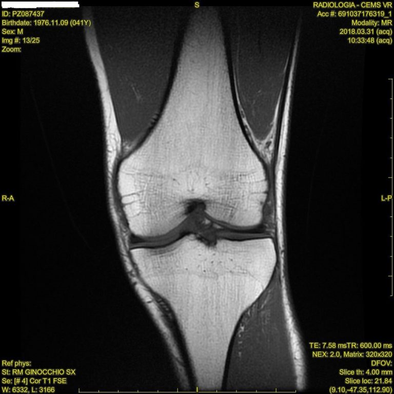 risonanza magnetica ginocchio sx