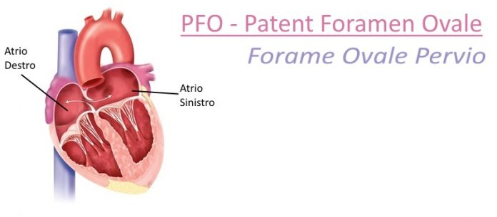 Forame Ovale Pervio
